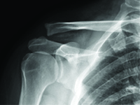 Migracja złamanego drutu Kirchnera po zespoleniu zwichniętego stawu barkowo- obojczykowego — opis przypadku