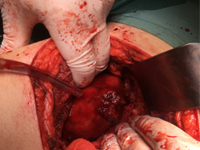 Zespół Wunderlicha objawiający się samoistnym krwotokiem nerkowym w jamie zaotrzewnowej jako pierwsza manifestacja raka nerkowokomórkowego