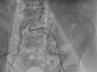 Pacjent z wielonaczyniową chorobą wieńcową i schyłkową niewydolnością nerek leczony wielokrotnymi przezskórnymi interwencjami wieńcowymi